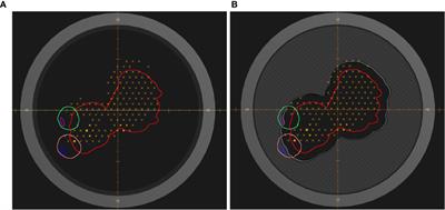 Clinical Implementation of Proton Therapy Using Pencil-Beam Scanning Delivery Combined With Static Apertures